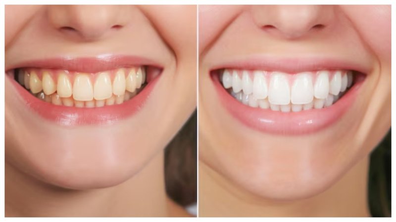 teeth whitening home remedies