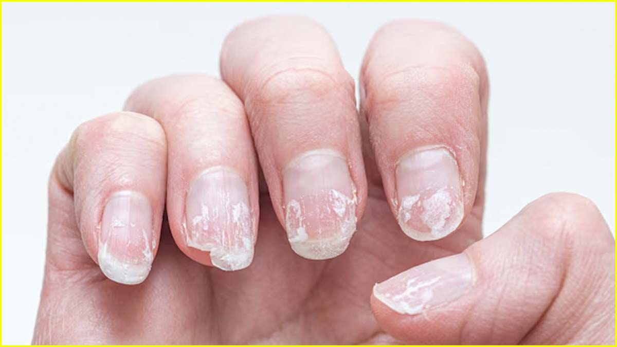 Brittle Nails