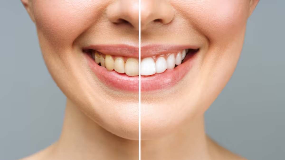 Teeth Brightening Remedies