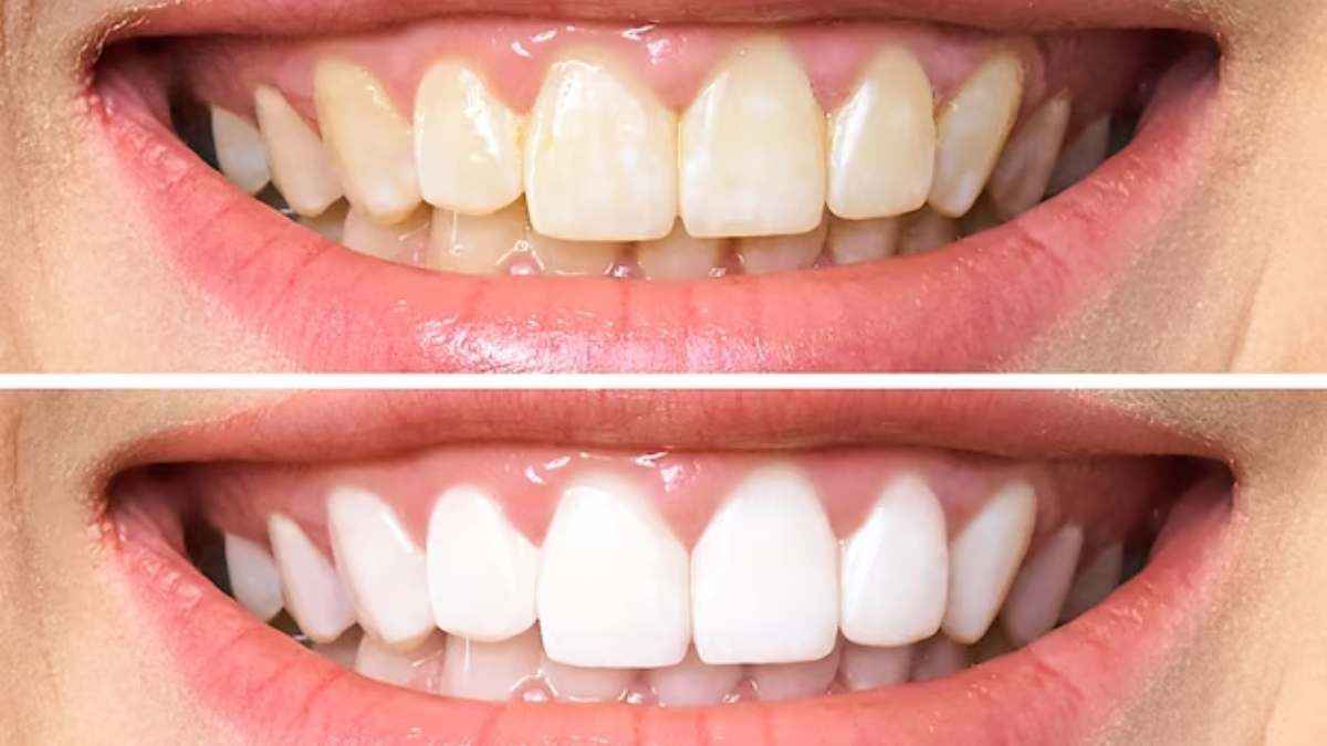 Teeth Brightening: पीले दांतों से हमेशा-हमेशा के लिए छुटकारा दिलाएगी यह जोड़ी, फॉलो करें सिंपल घरेलू नूस्खा