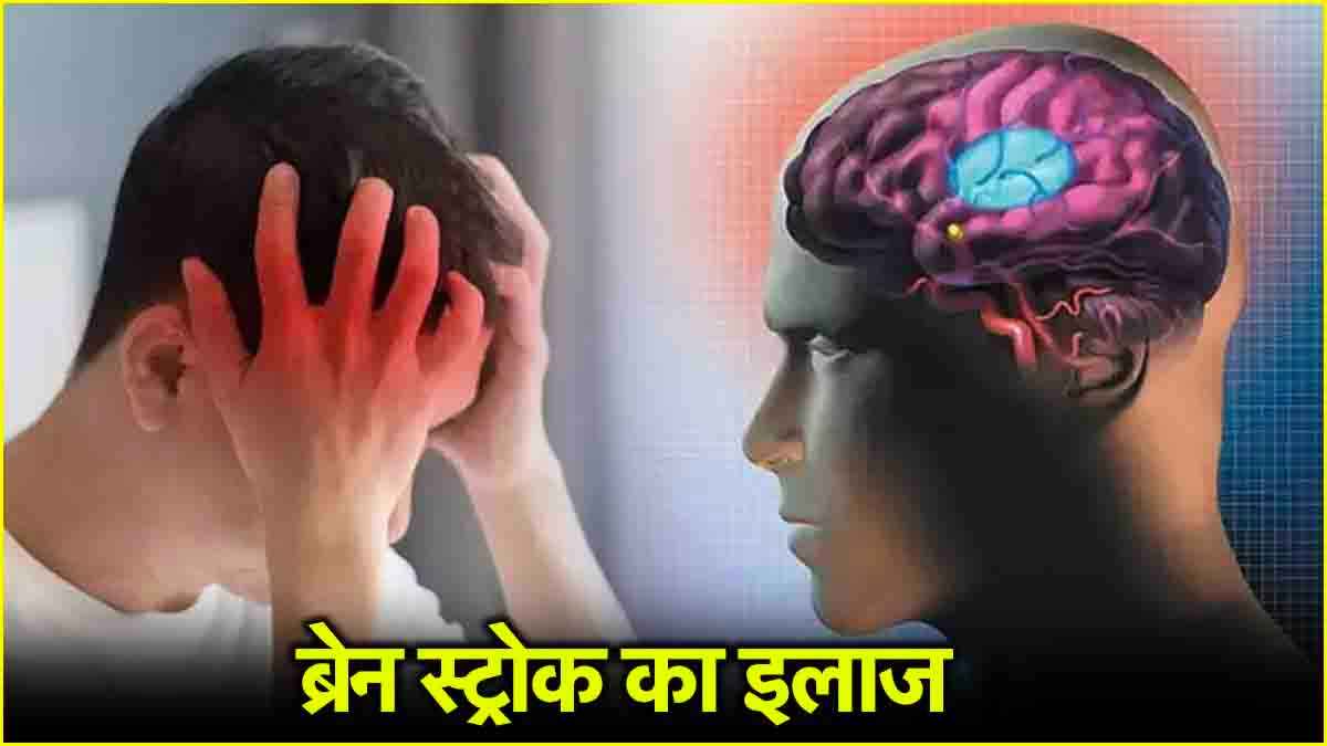 Brain Stroke के शुरुआती लक्षण क्या? कहीं आप तो नहीं कर रहे अनदेखा, क्या इलाज संभव?