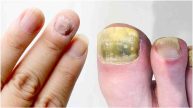 Nail fungal infection