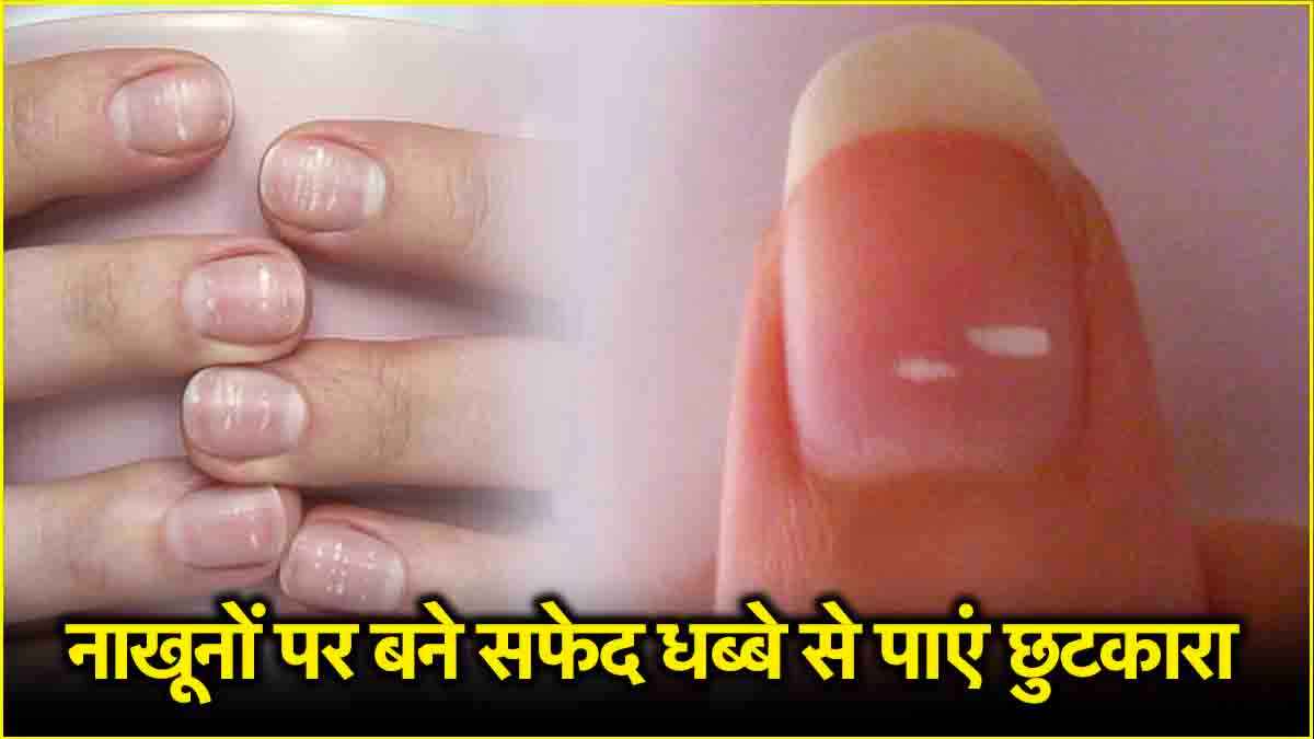 White Spots on Nails: नाखूनों पर सफेद धब्बे बीमारी का संकेत, इन घरेलू उपायों से पाएं छुटकारा