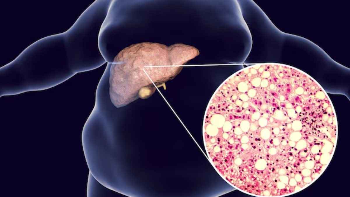 fatty liver