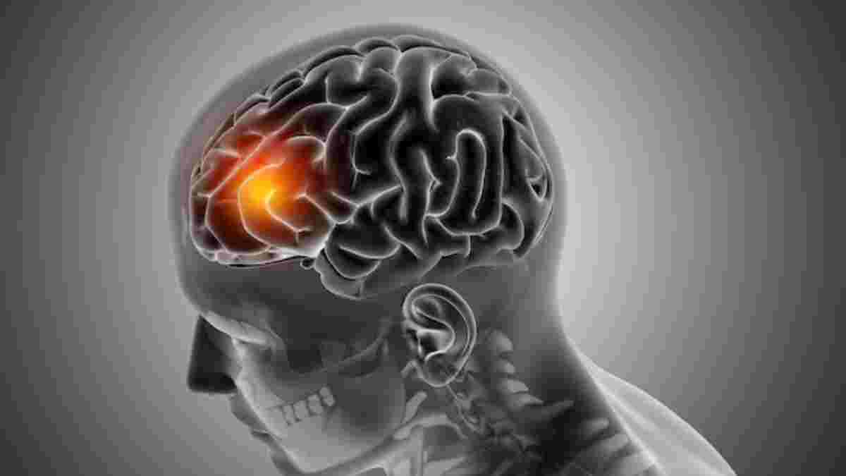 brain stroke causes