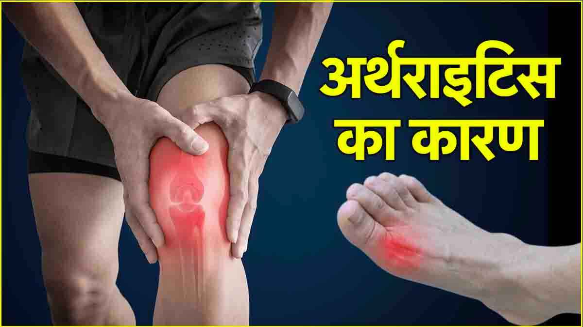बॉडी में यूरिक एसिड बढ़ने से होता है गठिया! जानें बचाव के उपाय
