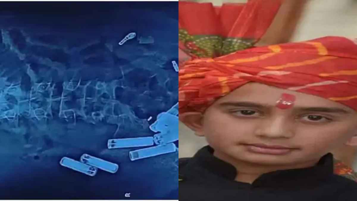 बैटरी, चेन, स्क्रू, ब्लेड... 14 साल के लड़के के पेट से डाॅक्टरों ने निकाली 56 चीजें, हाथरस से दिल्ली तक मौत से जंग