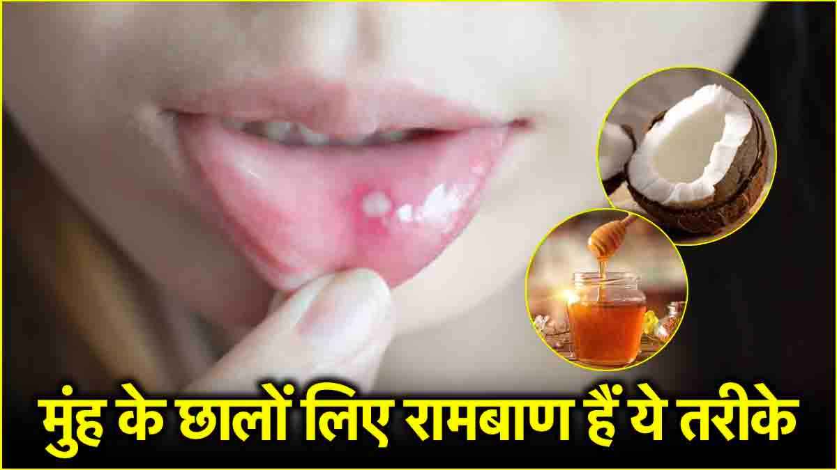 Mouth Ulcers: क्या आप भी हैं मुंह के छालों से परेशान? अपनाएं ये 3 घरेलू उपाय
