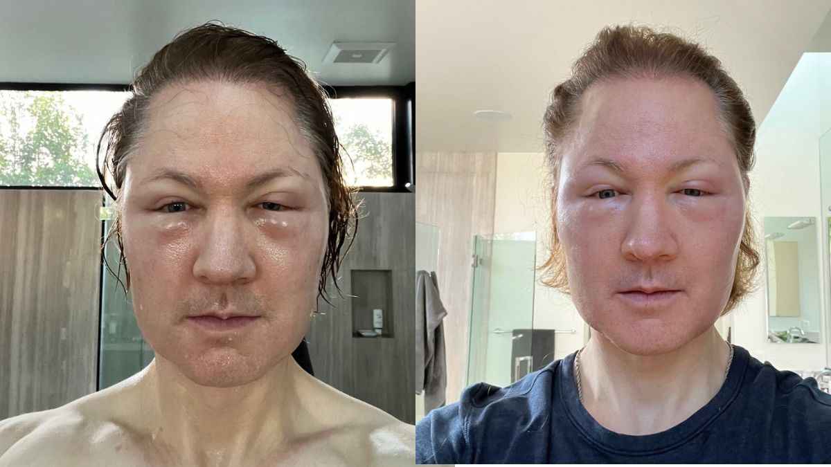 जब Anti-aging एक्सपेरिमेंट ने बजाई बैंड, कुछ समय के चली गई आंखों की रोशनी