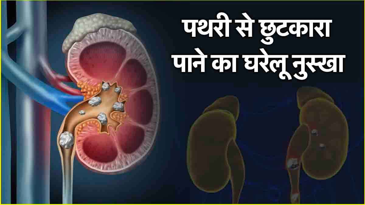 बड़ी से बड़ी पथरी को गला देगा आचार्य मनीष का यह ड्रिंक, मरीज आज से ही करें सेवन