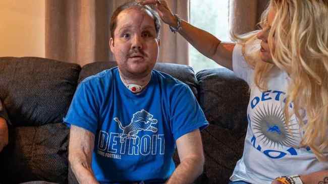 US Man Receives Successful Face Transplant