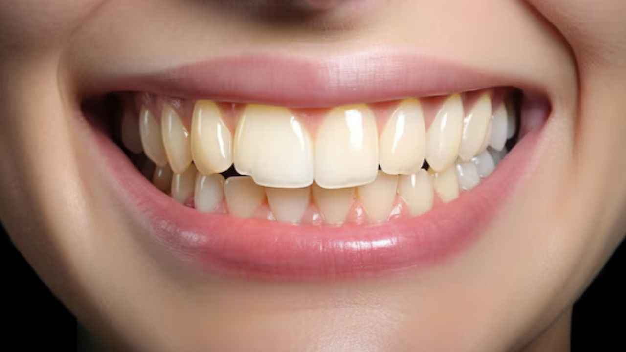 Yellow Teeth Problem: क्या आपके भी दांत हंसने पर दिखते हैं पीले, चमकाने के लिए अपनाएं ये घरेलू नुस्खे