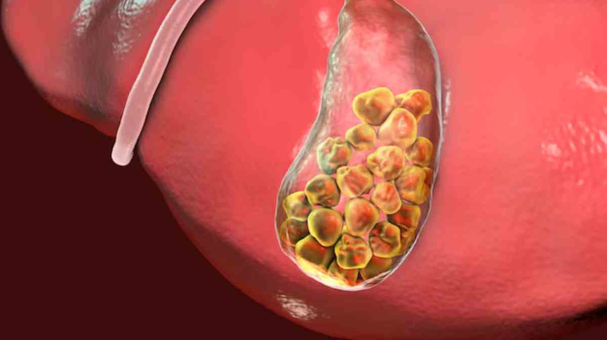 gallstones symptoms