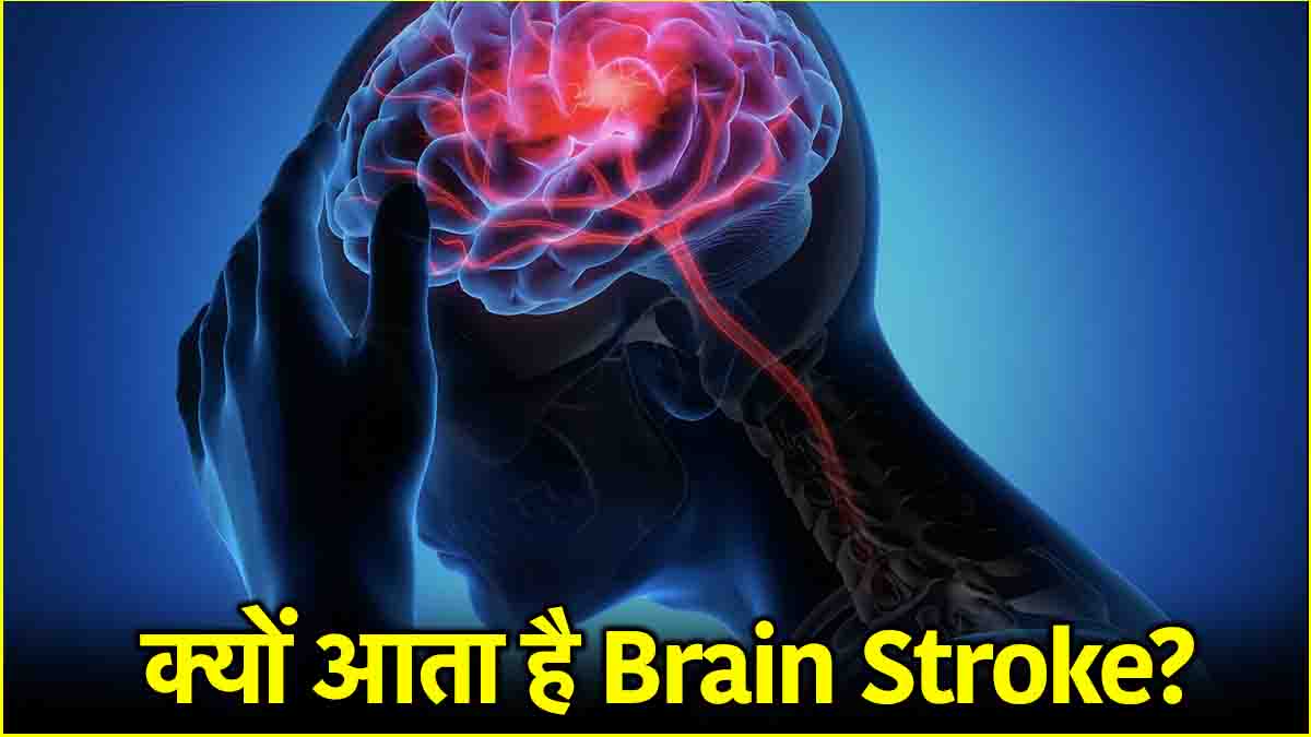 Brain Stroke Causes