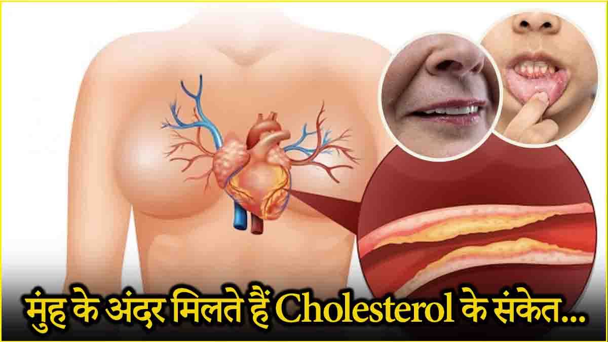 Cholesterol Symptoms