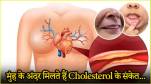 Cholesterol Symptoms