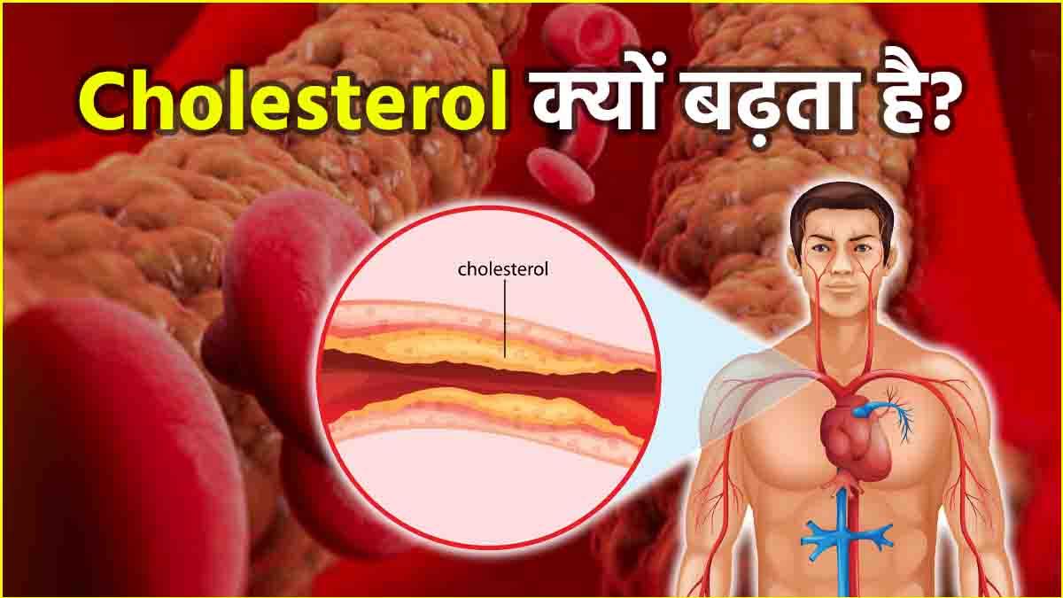 Cholesterol Causes