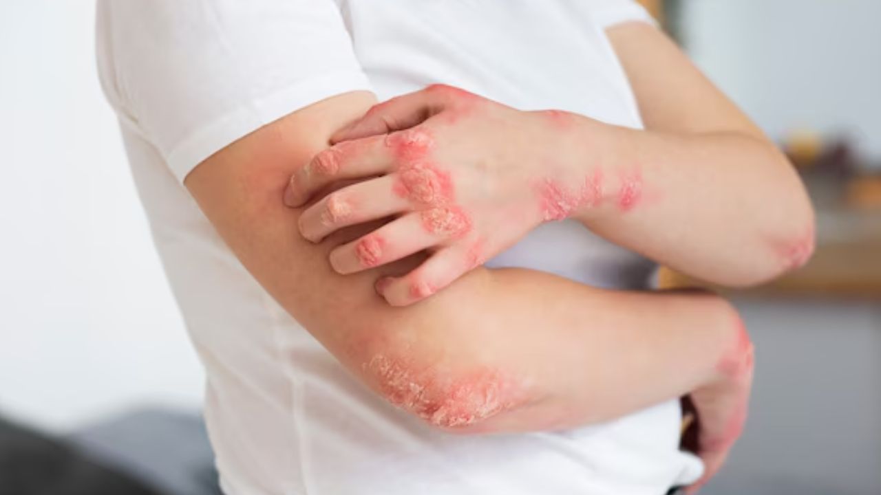 Psoriasis Treatment