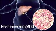 Fatty Liver Disease