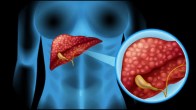 Liver Cancer Signs