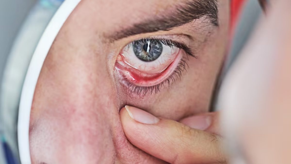 Deadly Eye Virus Symptoms