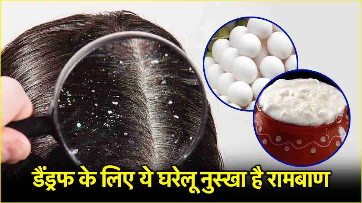 Hair Care Tips: डैंड्रफ दूर करने के लिए घर पर बनाएं ये 3 हेयर मास्क, जानें इस्तेमाल करने का तरीका