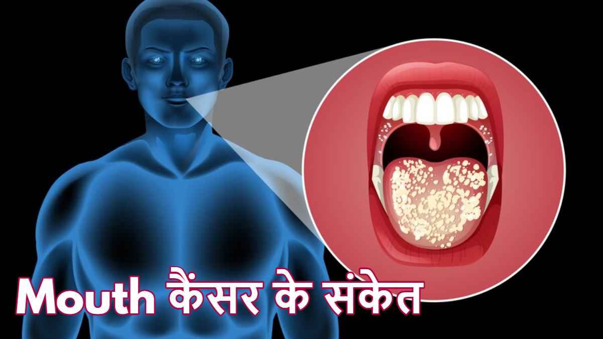 दांत कब बन जाते हैं  कैंसर का कारण? जानिए एक्सपर्ट की राय