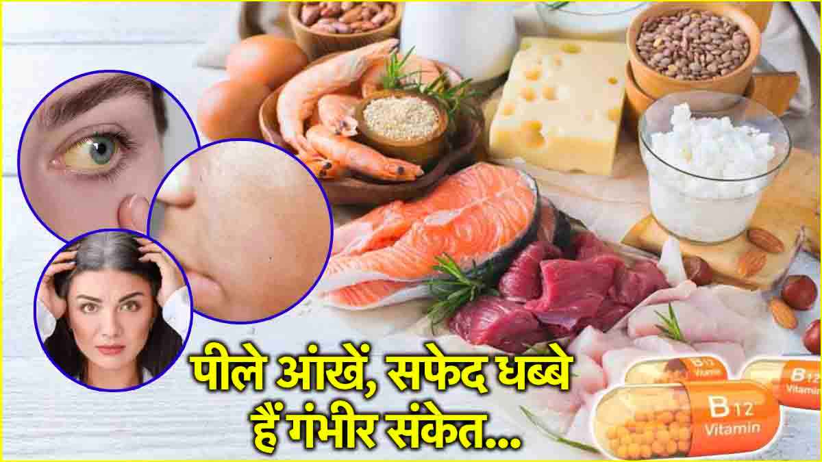 Vitamin B12 Deficiency
