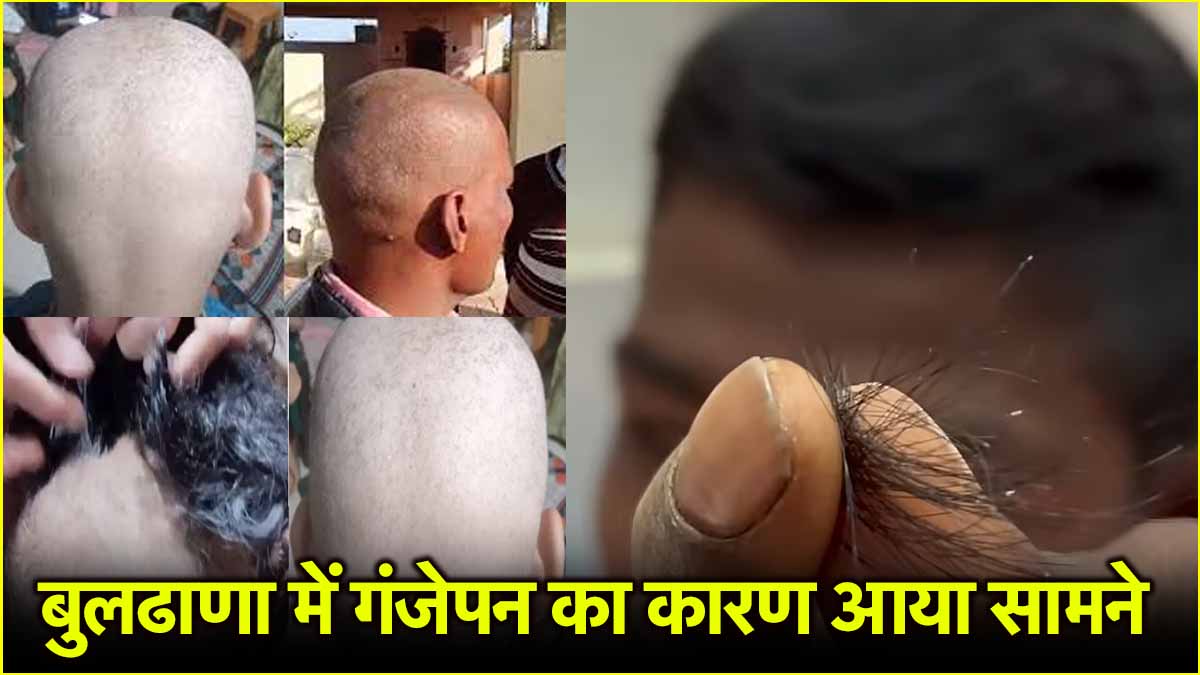 Buldhana Hair Loss Disease