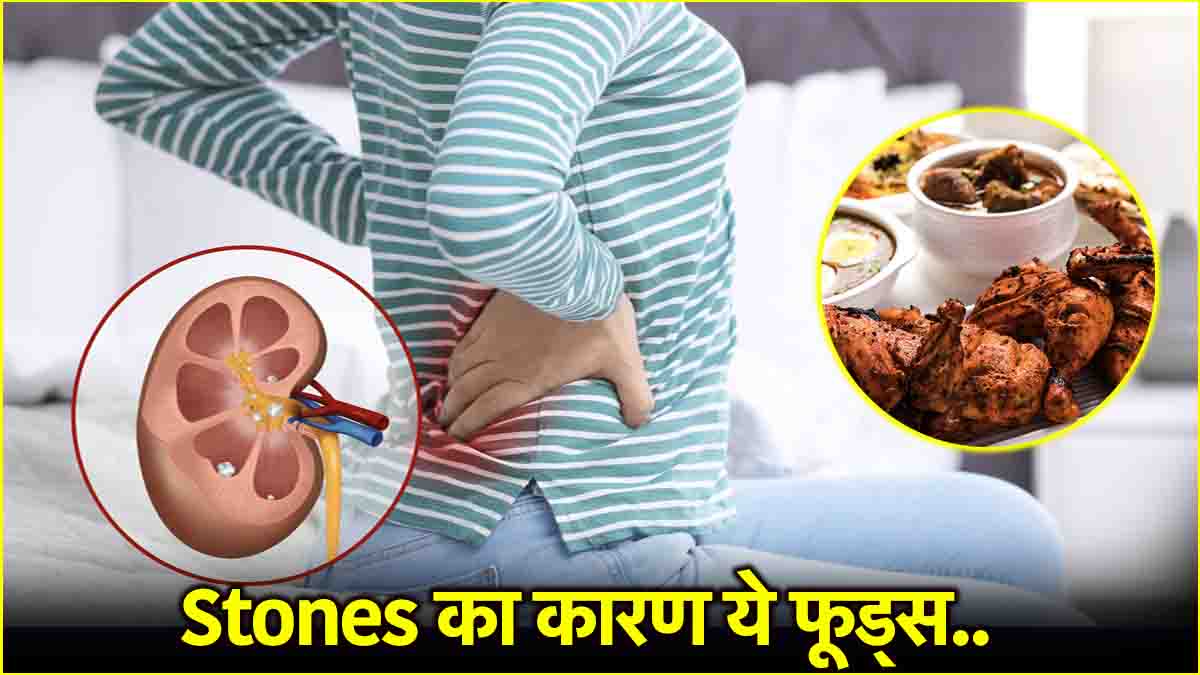 Kidney Stones Tips