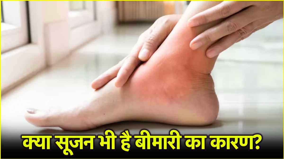 Health Tips: शरीर में बिना कारण के सूजन हो सकती है इस बीमारी का संकेत! जानें एक्सपर्ट की राय
