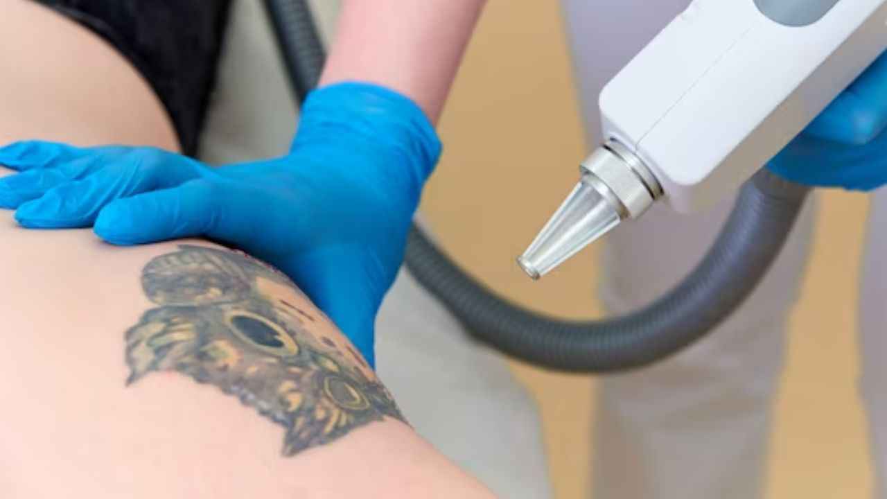 Tattoo Removal Tips: कैसे पा सकते है टैटू से छुटकारा? जानें क्या कहते हैं स्किन एक्सपर्ट