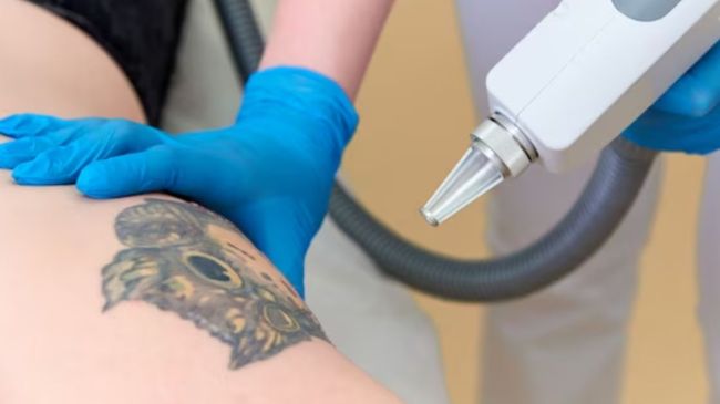 Tattoo Removal Tips