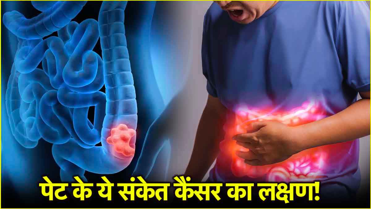 Symptoms of colon cancer,