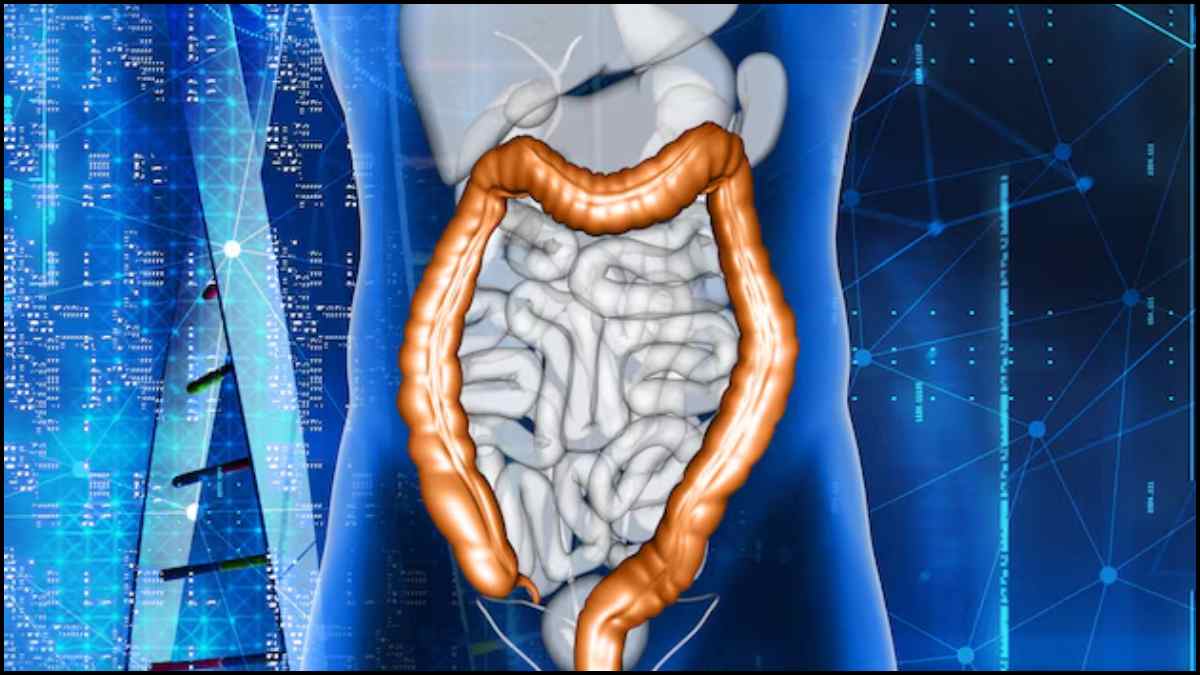 Colon Cancer