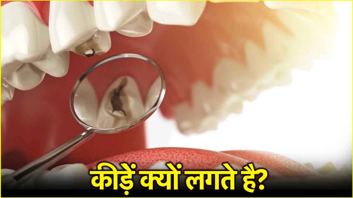 Cavity Causes: दांतों में कीड़ों को बढ़ावा देते हैं ये 5 फूड, जानें एक्सपर्ट एडवाइस