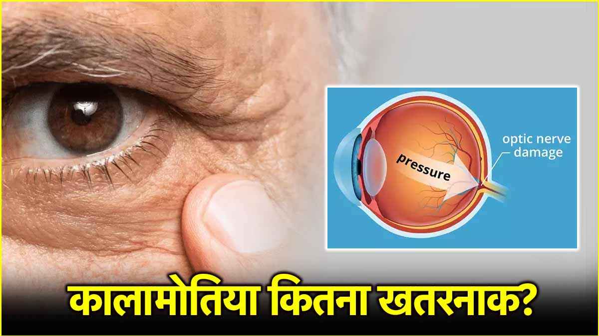 Glaucoma आंखों की कैसी बीमारी है? एक्सपर्ट्स से जानिए इससे बचने के तरीके