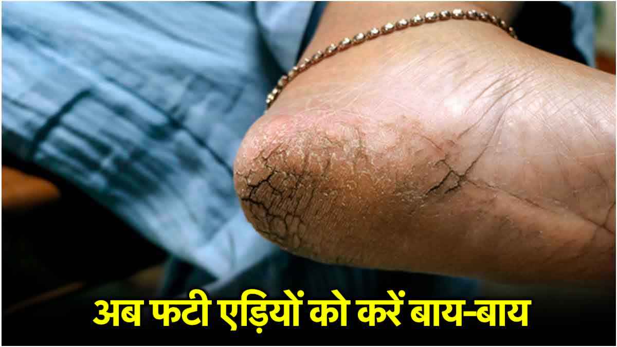 Cracked Heel Remedies: इस तरह रखें अपने पैरों का ध्यान, लोग देख रहे जाएंगे हैरान