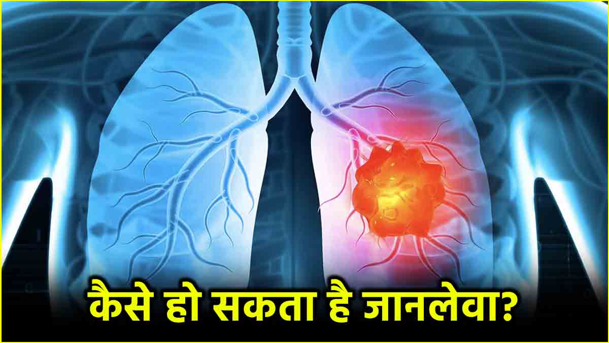 Lung Cancer Symptoms