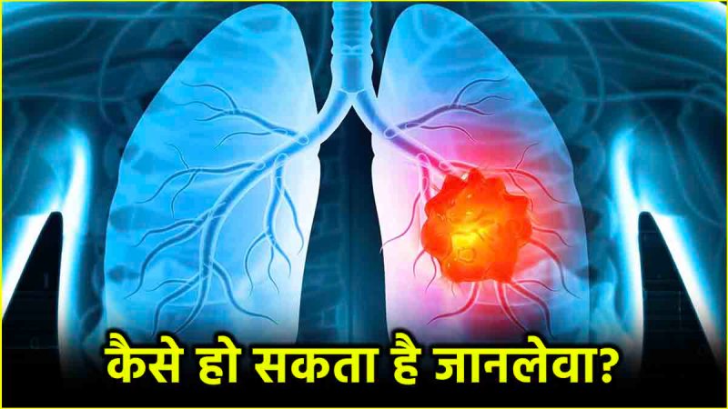 Lung Cancer Symptoms