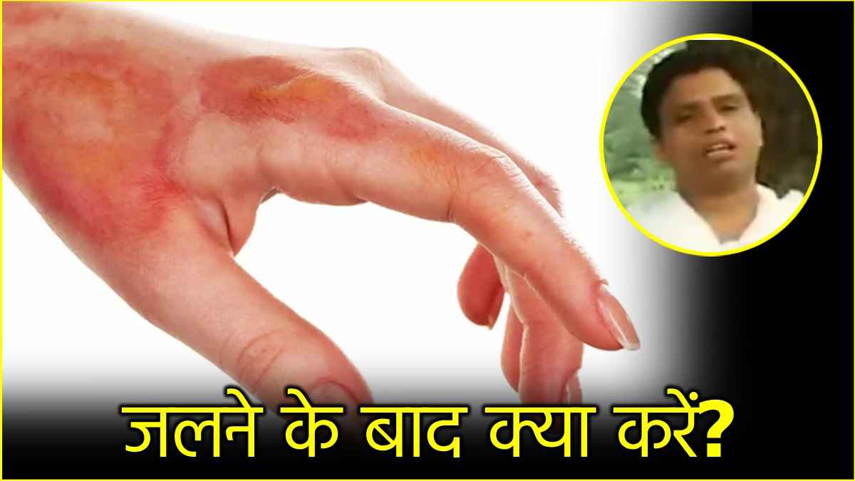 आग से जलने पर तुरंत राहत पहुंचाते हैं इस पेड़ के पत्ते, आचार्य बालकृष्ण ने बताया नुस्खा