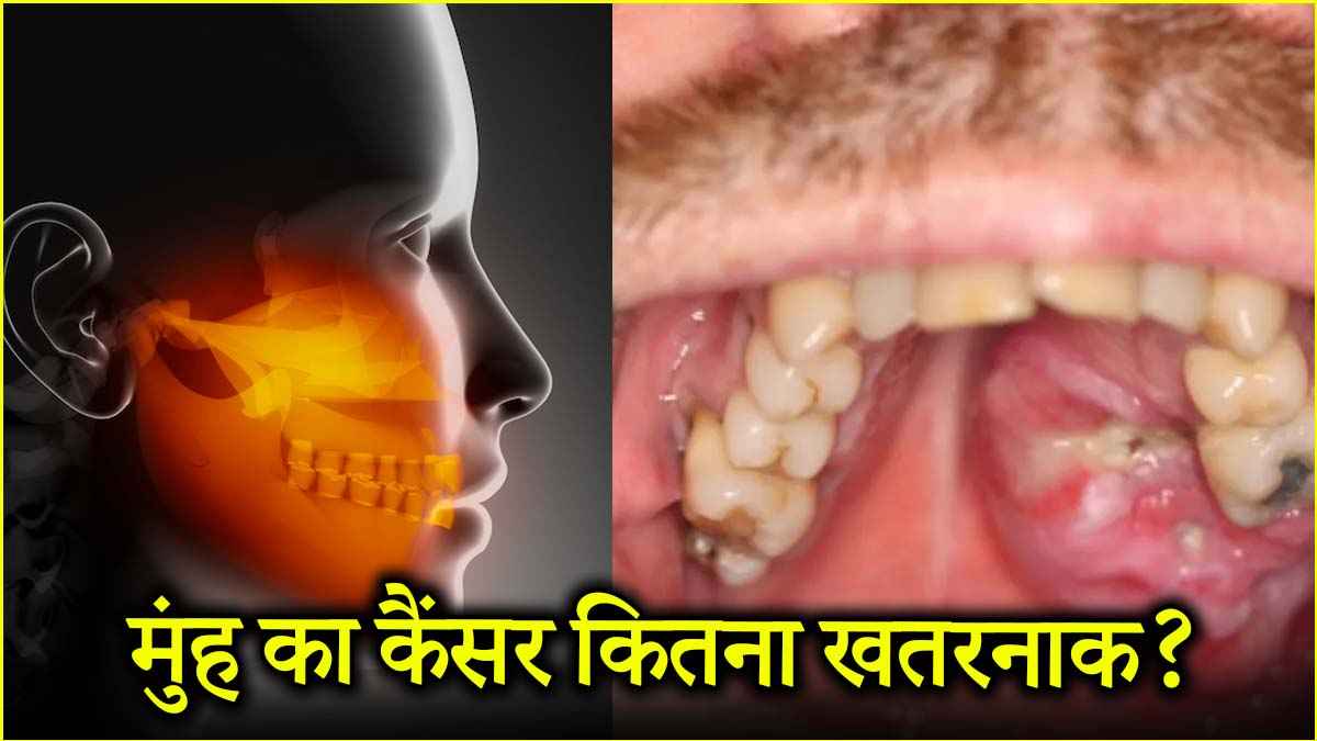 Jaw Cancer