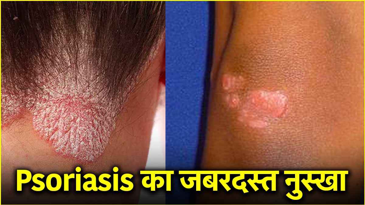 Psoriasis