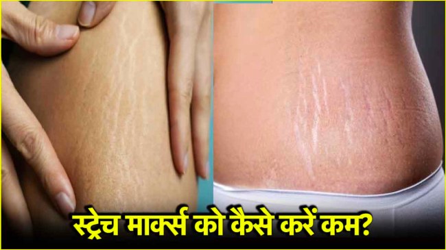 Stretch Marks