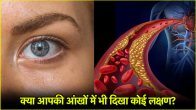 cholesterol signs in eyes