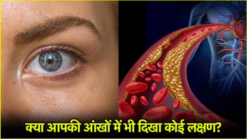 cholesterol signs in eyes