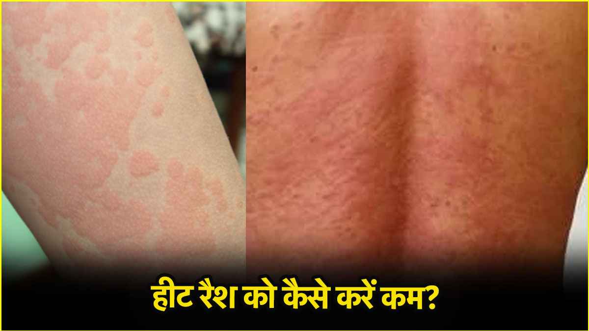 हीट रैश और त्वचा की जलन से हैं परेशान? एक्सपर्ट से जानें बचाव  
