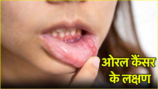 oral cancer signs