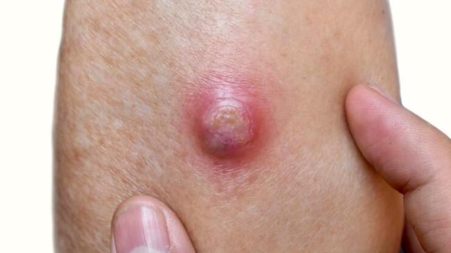 body lumps-1-2-3-4-5