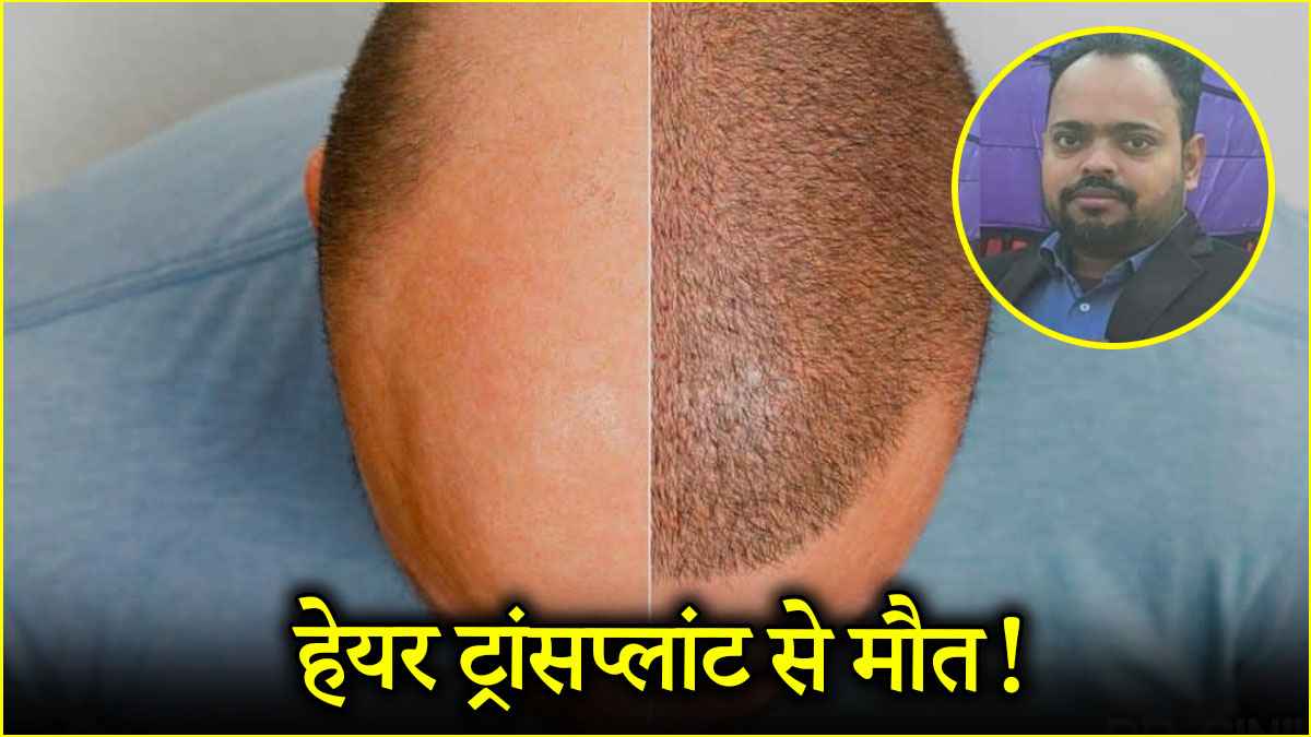 Hair Transplant (1)